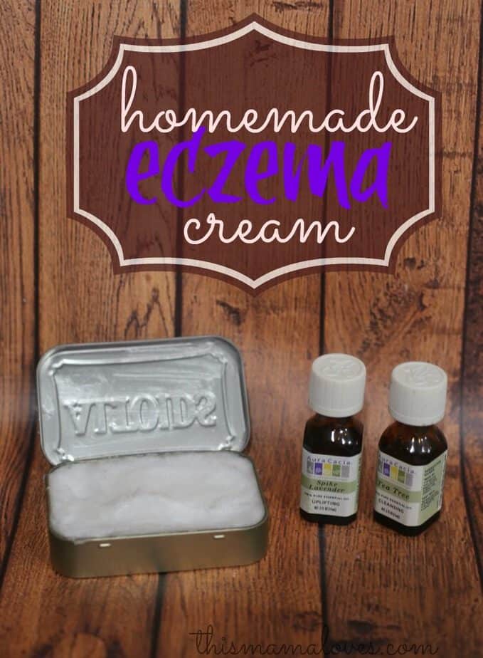 Homemade Eczema Cream Recipe This Mama Loves 9659